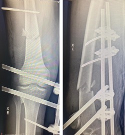 Tratamento De Fraturas Do F Mur Distal Dr Leonardo Rocha Thomaz