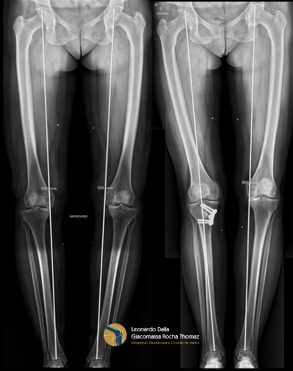 Osteotomias Do Joelho Dr Leonardo Rocha Thomaz