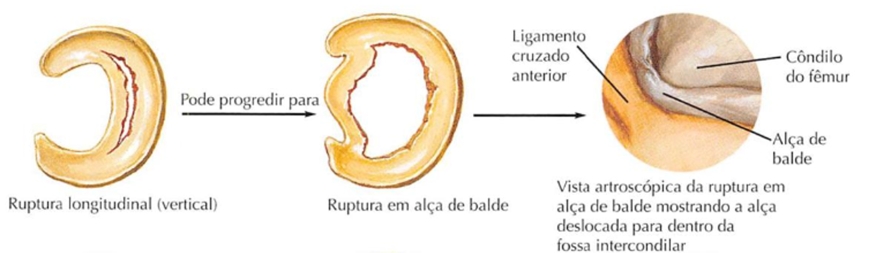 Lesão do Menisco - Dr. Leonardo Rocha Thomaz
